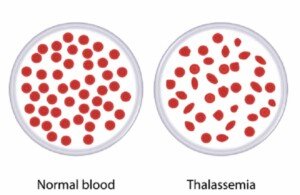 Formulate policies to prevent spread of thalassemia: HC