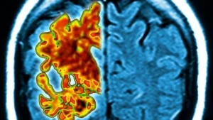 Medicine stopped in 1980s linked to rare Alzheimer’s cases