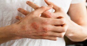 Can weight loss help in treating psoriasis?