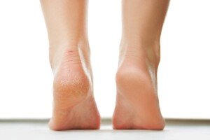 Home remedies for dry, cracked feet