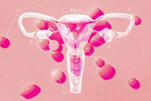 PCOS symptoms are still difficult for doctors to diagnose and treat. Here’s why