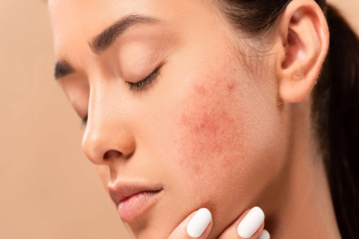 Acne spots, a stubborn reminder that you need glutathione