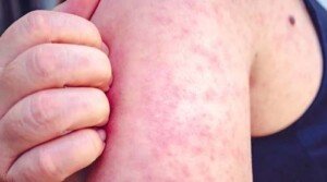 Measles cases surging again in Europe: WHO
