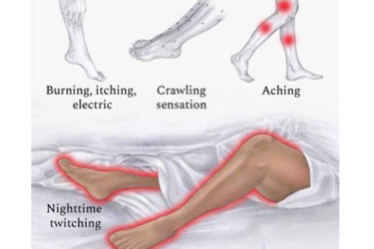 Scientists find treatment for restless leg syndrome