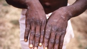 Health ministry issuesMpox alert in Bangladesh