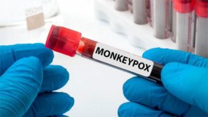 Temperature screening for Mpox begins at Dhaka airport