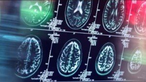 First drug to slow Alzheimer’s too costly for NHS