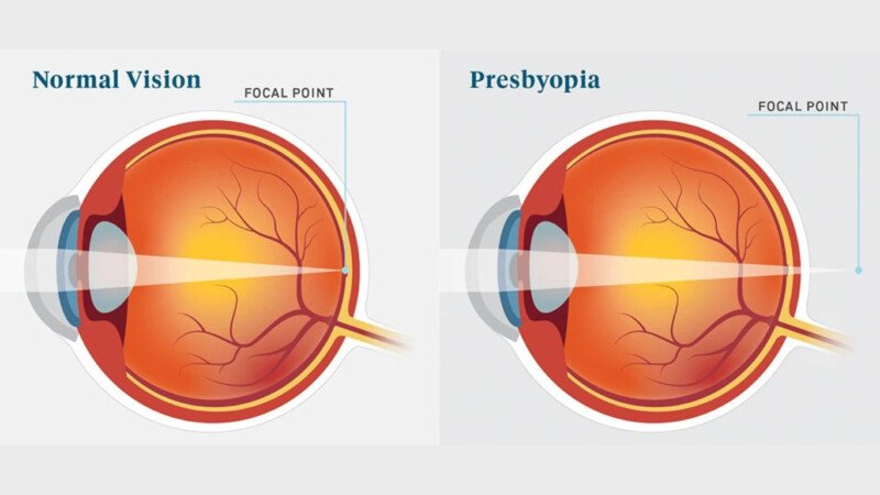 1 in 5 Bangladeshis, mostly aged 35+, has presbyopia