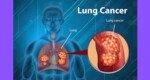 Lung cancer: An overview