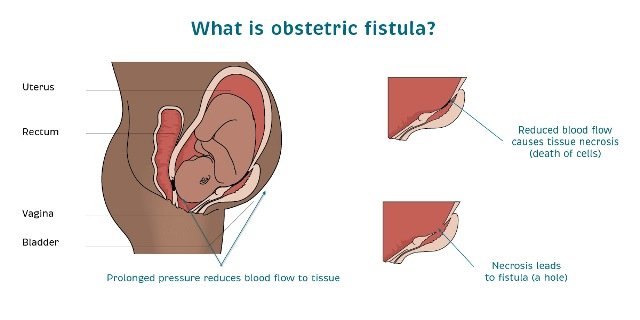 Bringing obstetric fistula patients under treatment underscored