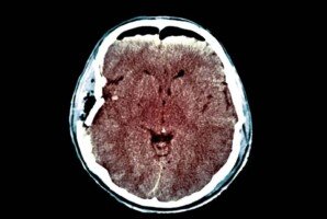A New System Aims to Save Injured Brains and Lives