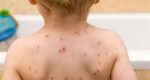 Children to be offered chickenpox vaccine on NHS