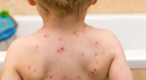 Children to be offered chickenpox vaccine on NHS