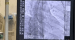 Bangladesh reduces prices for 10 types of heart stents from three international companies