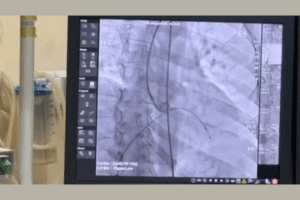 Bangladesh reduces prices for 10 types of heart stents from three international companies