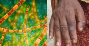 8 anthrax patients identified in Rangpur