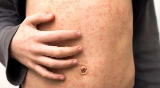 ‘Fast-spreading’ measles outbreak hits several schools in London