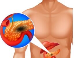 Deadly pancreatic cancer risk factors no one should ignore