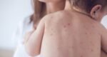 Measles: Causes, symptoms, transmission, and increased risks for unvaccinated children