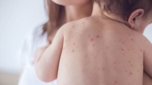 Measles: Causes, symptoms, transmission, and increased risks for unvaccinated children