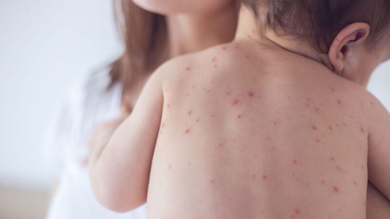 Measles: Causes, symptoms, transmission, and increased risks for unvaccinated children