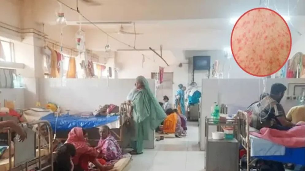 Measles kills 15 children; Rajshahi most affected region