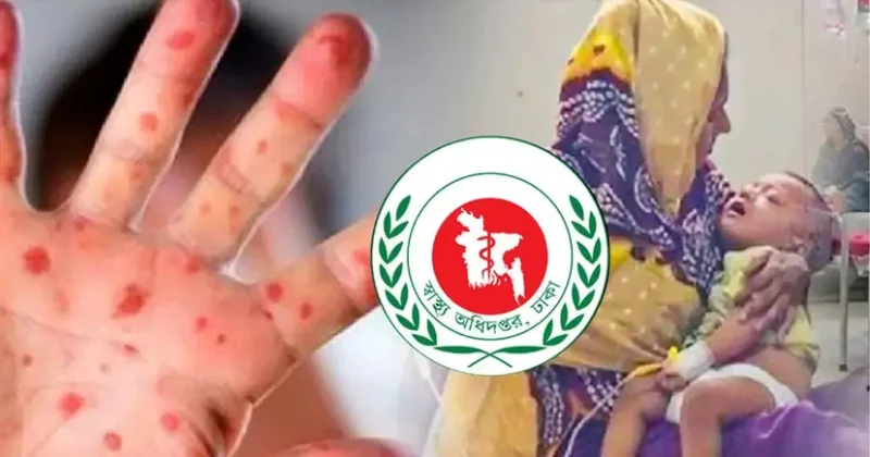 Two more children die with measles-like symptoms in Sylhet