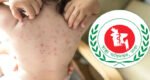 One more child dies with measles-like symptoms in Sylhet