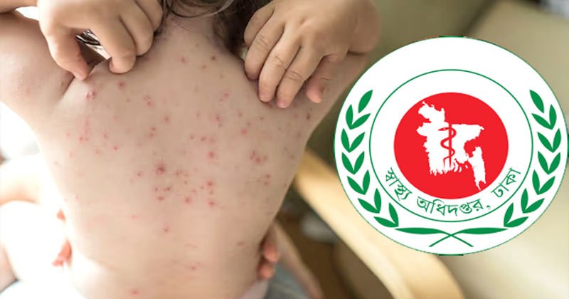 One more child dies with measles-like symptoms in Sylhet
