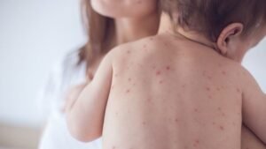 11 die from measles, symptoms in 24 hours
