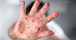 Avoid unnecessary travel with children amid measles risks, warns experts