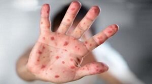 Avoid unnecessary travel with children amid measles risks, warns experts