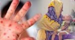 10 more children die of measles, symptoms in 24hrs