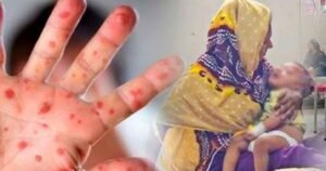 10 more children die of measles, symptoms in 24hrs