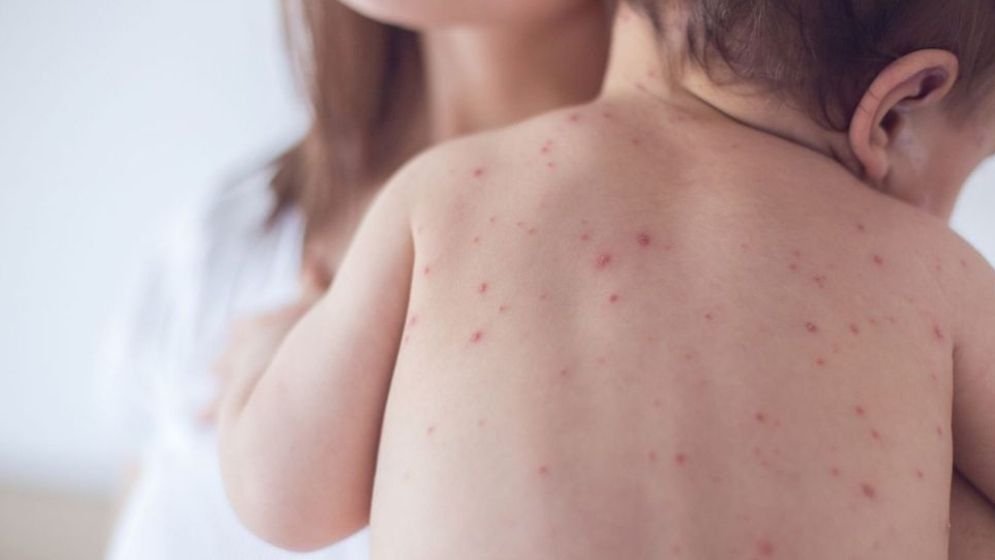 Six more children die of measles, symptoms in 24hrs