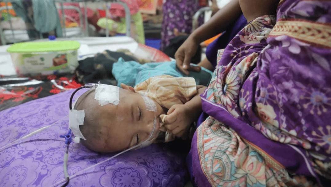 3 children die in one day due to measles symptoms in Sylhet