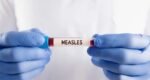 Five die with measles symptoms, 1,170 new cases reported