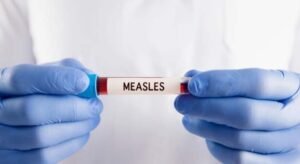 Five die with measles symptoms, 1,170 new cases reported