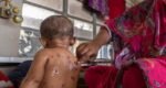 3 more children die of measles; nationwide toll rises to 860