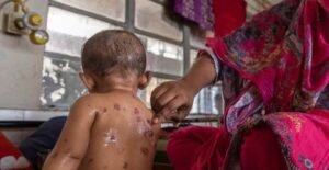 3 more children die of measles; nationwide toll rises to 860