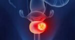 New non invasive urine test may replace cystoscopy for bladder cancer