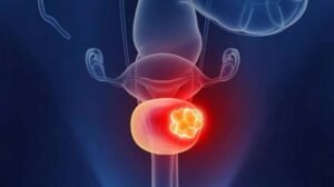 New non invasive urine test may replace cystoscopy for bladder cancer