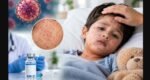 Measles : Treatment, prevention and what parents should do
