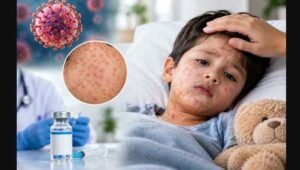 Measles : Treatment, prevention and what parents should do