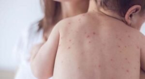 Six more children die with measles-like symptoms in 24 hours