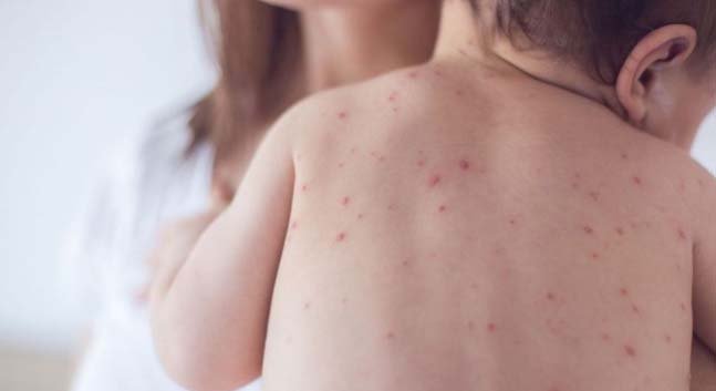 Six more children die with measles-like symptoms in 24 hours