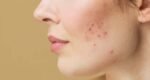 Adult acne is common, but effective treatments are available