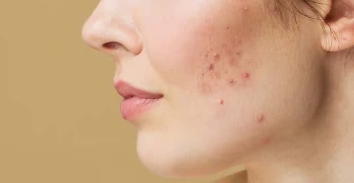 Adult acne is common, but effective treatments are available